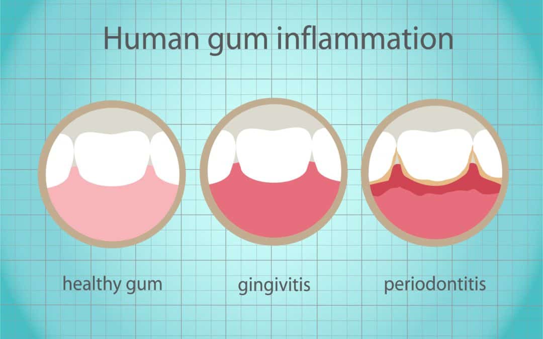 Gum Disease Can Devastate Your Smile | Family & Implant Dentistry